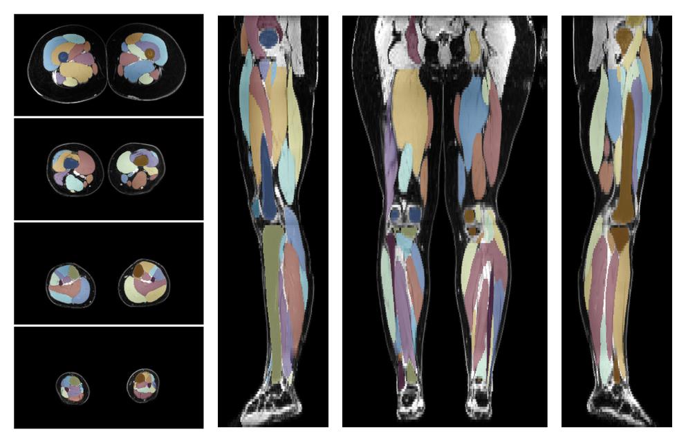 Overlay of automated muscle segmentation labels on dixon water image.